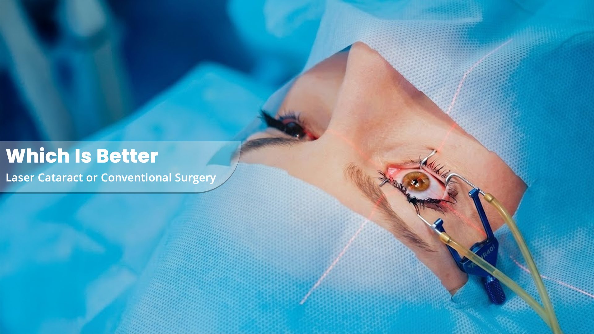 Which Is Better Laser Cataract or Conventional Surgery